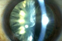 Esempio di cataratta. Si noti la presenza e la forma delle opacit� del cristallino, in questo caso prevalentemente corticali. La pupilla � molto dilatata grazie ad appositi colliri.