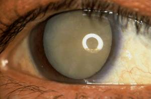 Esempio di cataratta totale. La pupilla � molto dilatata grazie ad appositi colliri.