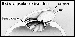 Intervento di estrazione extracapsulare della cataratta. Dopo aver praticato un'incisione tra la cornea e la sclera, si estrae il cristallino in un solo blocco, lasciando al suo posto unicamente una parte della capsula. Successivamente si pu� impiantare un cristallino artificiale.