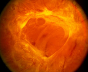 Fibrosi e distacco trazionale delle retina