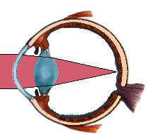 Occhio emmetrope: le immagini dall'infinito sono proiettate esattamente sulla retina.