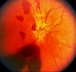 EMOVITREO; si pu� osservare la presenza di sangue (chiazza scura) nel vitreo, quindi al davanti della retina