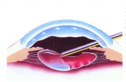 Facoemulsificazione del cristallino catarattoso. Le immagini mostrano l'intervento in due tempi successivi.