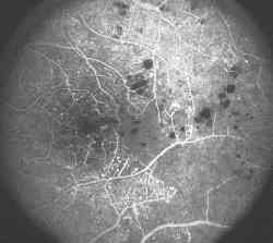 Fluorangiografia della retina di un paziente affetto da retinopatia diabetica