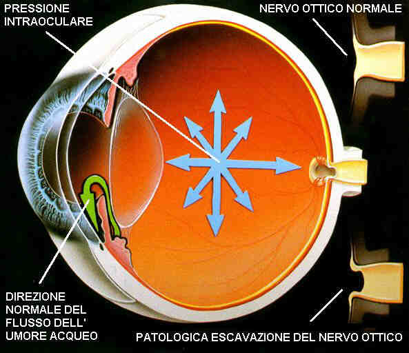 Anatomia dell'occhio. Si noti la circolazione dell'umore acqueo (in verde), la distribuzione della pressione a tutto l'occhio, e l'aumento della escavazione fisiologica del disco ottico.