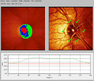 Esempio di analisi computerizzata (topografia) del disco ottico