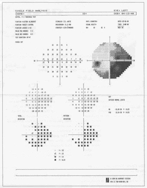 Aumento della escavazione del disco ottico nel glaucoma