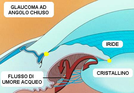 Schema anatomico dell'occhio durante un attacco di glaucoma acuto. in GIALLO i punti dove si pu� verificare l'ostruzione al flusso dell'umore acqueo