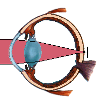 OCCHIO IPERMETROPE: Le immagini vanno a fuoco dietro la retina