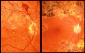 Esempio di laserterapia in un caso di retinopatia diabetica. Nella foto a sinistra la retina prima del trattamento. In quella a destra, dopo laserterapia. Si vede la zona periferica trattata. La zona centrale ora appare in condizioni migliori