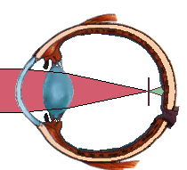 OCCHIO MIOPE: le immagini vanno a fuoco al davanti della retina