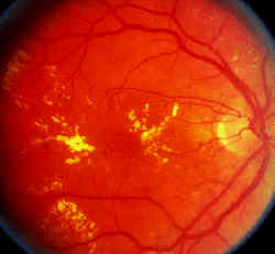 IL DIABETE E L'OCCHIO: LA RETINOPATIA DIABETICA