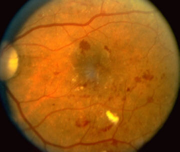 RETINA AFFETTA DA RETINOPATIA DIABETICA NON PROLIFERANTE. Si possono osservare le emorragie, i microaneurismi, e zone di edema retinico.