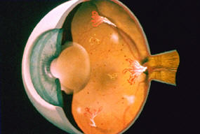 RETINA AFFETTA DA RETINOPATIA DIABETICA PROLIFERANTE: Si possono osservare i neovasi a livello della retina e del disco ottico.