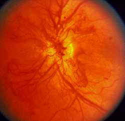 RETINA AFFETTA DA RETINOPATIA DIABETICA PROLIFERANTE: Si possono osservare i neovasi a livello della retina e del disco ottico.